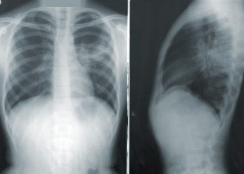 Tuberculosis is a global threat