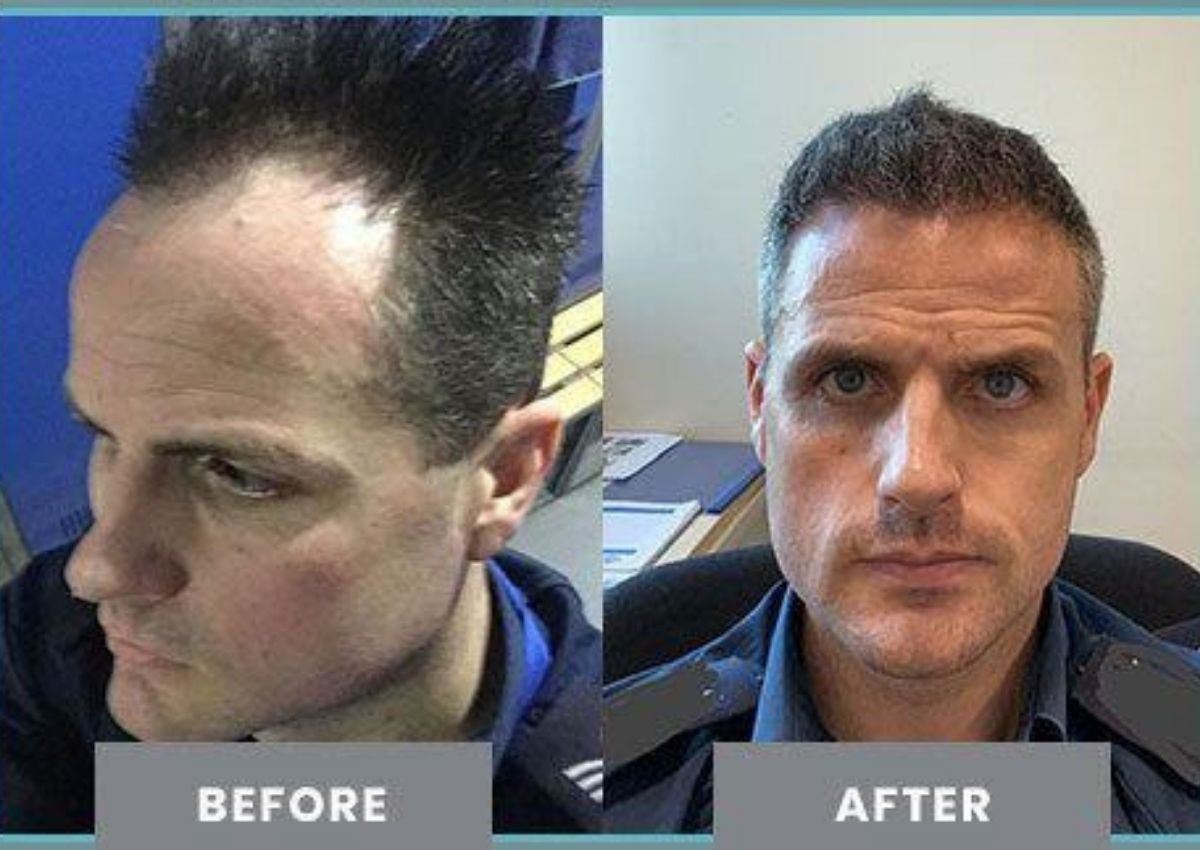 Sapphire Hair Clinic – A Look into Hair Transplant and What to Expect