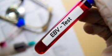 Epstein-Barr Virus Likely The Cause of Multiple Sclerosis