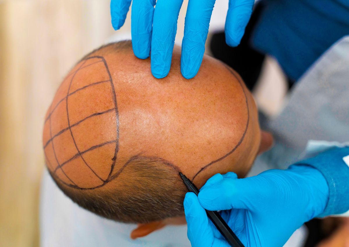 Dedicated to Beauty, Committed to Health: Why Estevien Clinic is the Best Place for Getting a Hair Transplant in Turkey
